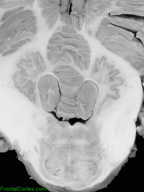 Pons Cerebellum Transverse